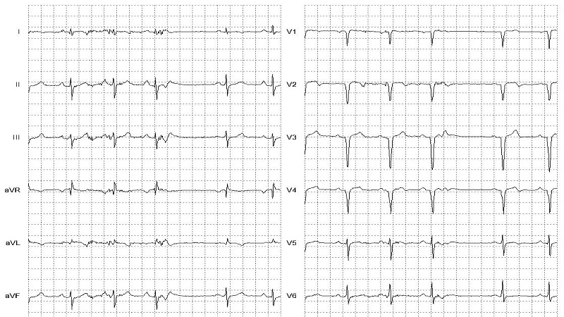 Atrial Paced Beat 12 Lead EKG